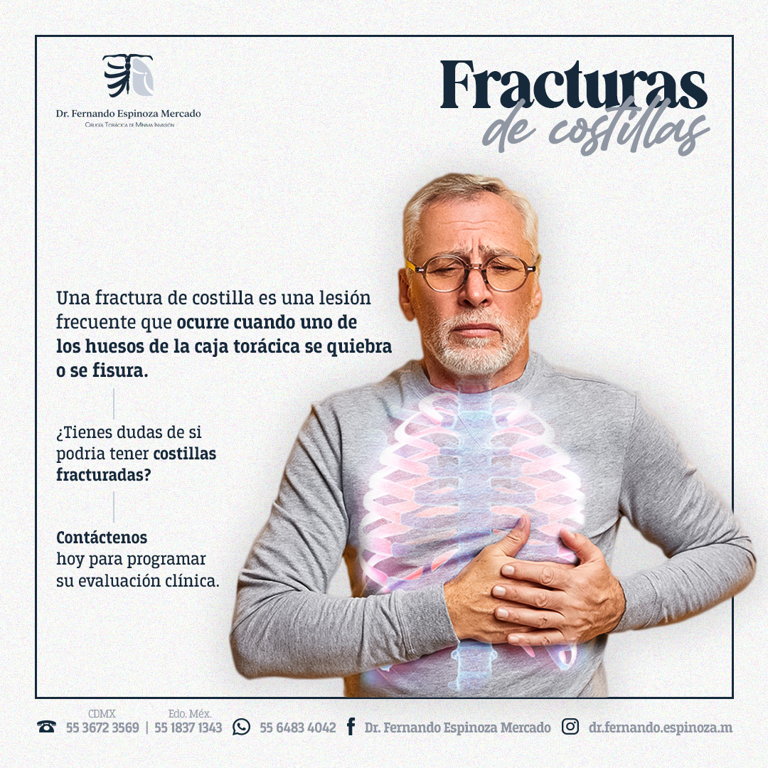 costillas, fractura de costilla, fractura de esternón, trauma torácico, torax inestable,doctor, Fernando Espinoza, cirujano, cirugía, torácica, tórax, salud, medicina, mínima, invasión, abdomen, pulmón