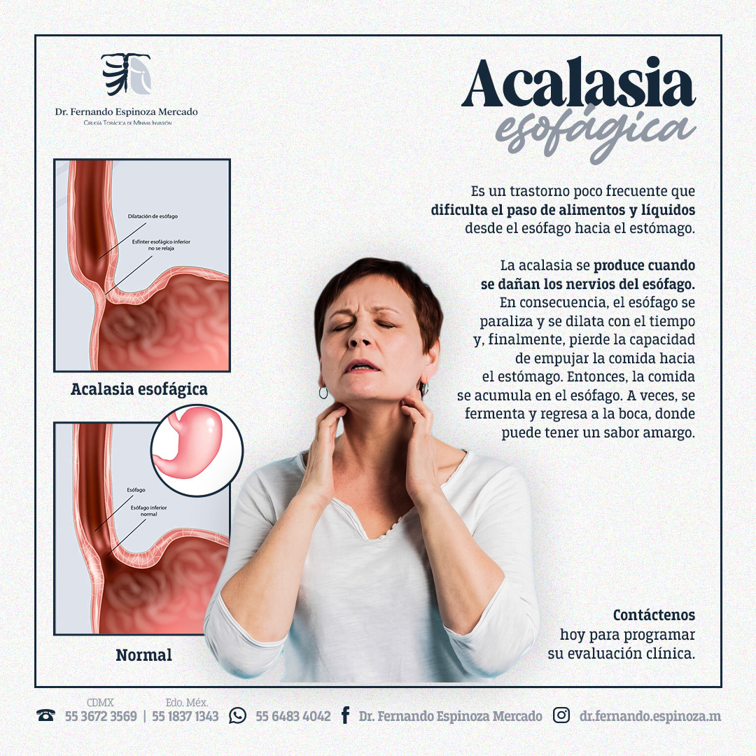 esofago, acalasia, ERGE, hernia hiatal, doctor, Fernando Espinoza, cirujano, cirugía, torácica, tórax, salud, medicina, mínima, invasión, abdomen, pulmón